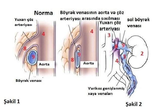Varikoselin səbəbləri, damar genişlənməsi, androloq Ziyad Əliyev Bakıda.