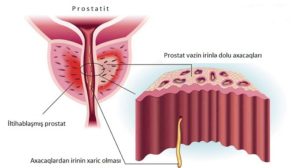 Xroniki prostatit müalicə, Bakıda, androloq, uroloq Ziyad Əliyev. Düzgün diaqnoz effektiv müalicənin qarantıdır. Prostatitin müalicəsi 