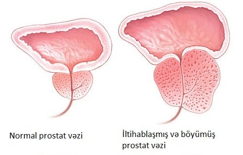 prostat böyüməsi