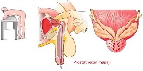 Prostat vəzin masajı