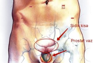 Prostat adenoması və şəkərli diabet zamanı sidik ifrazı-uroloq- androloq