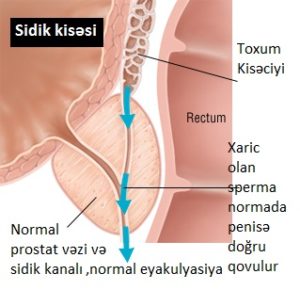 prostat vəzi kistası