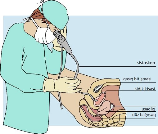 Sistoskopiya nədir - uretroskopiya nədir uroloq androloq bakıda, sistit- urologiya dr ziyad əliyev