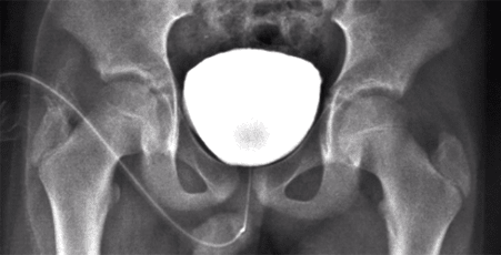 Prosztata masszírozó krónikus prosztatagyulladás esetén - A hátsó fáj a prostatitis miatt