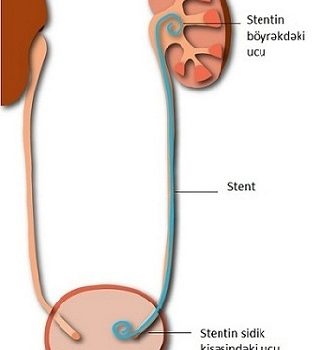 Stent nədir, böyrəkdə stent