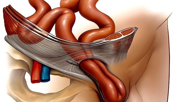 qasıq yırtığı, uroloq ziyad əliyev , androloq